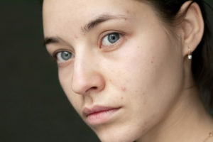 The Key Ingredient Missing in Your Acne Treatment